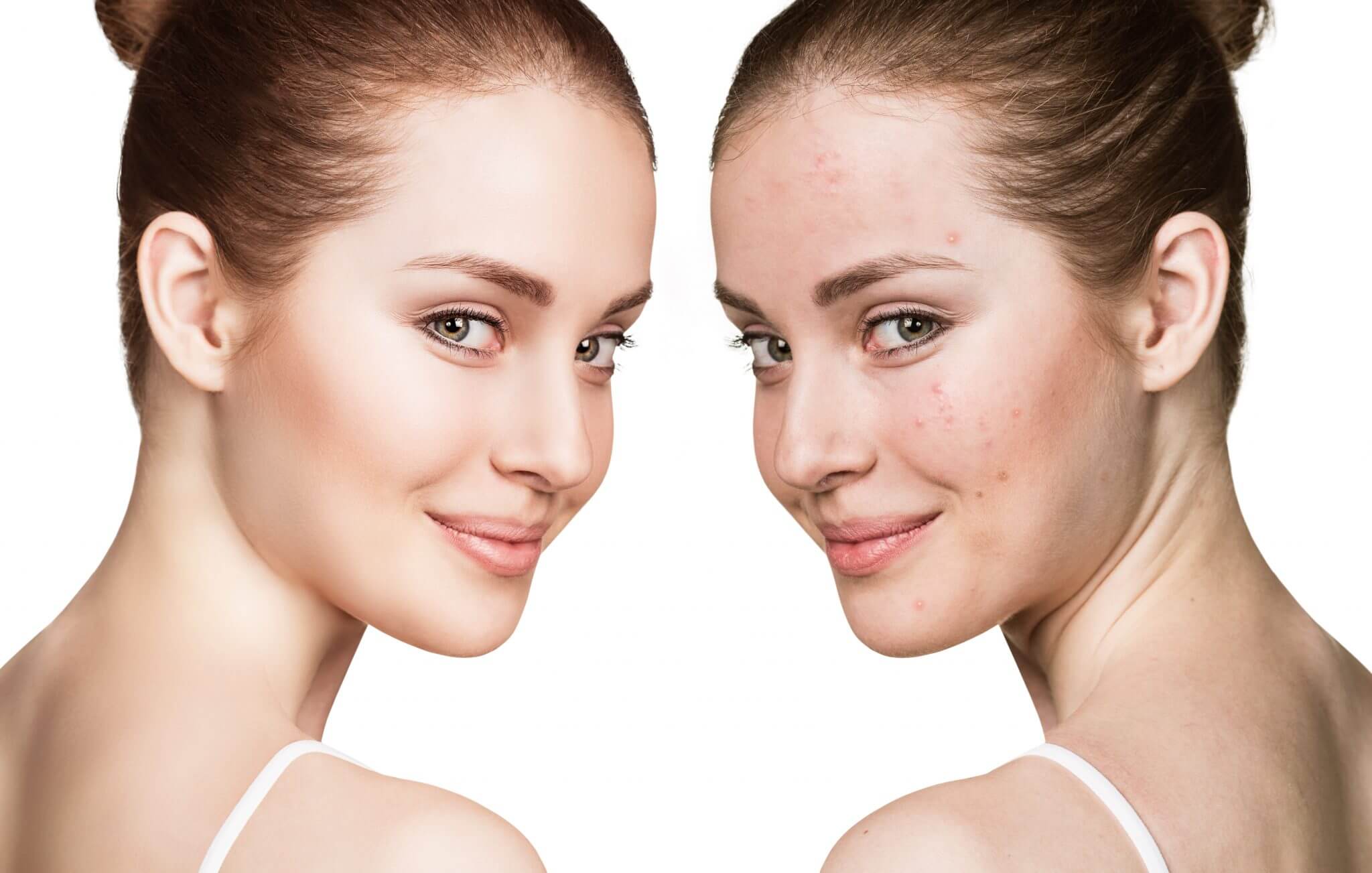women with acne then no acne